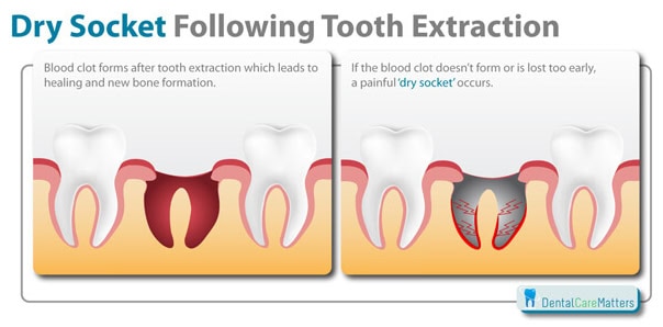 dental_dry_socket