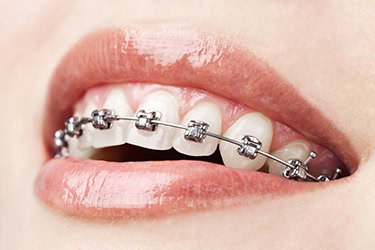 How Long Do I Need Braces? Factors That Influence Treatment Duration