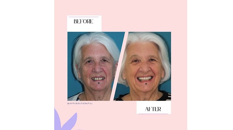 Implant Example
