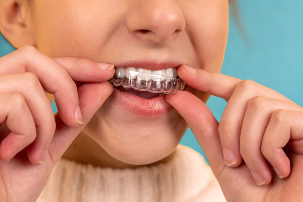 Woman inserting clear aligners