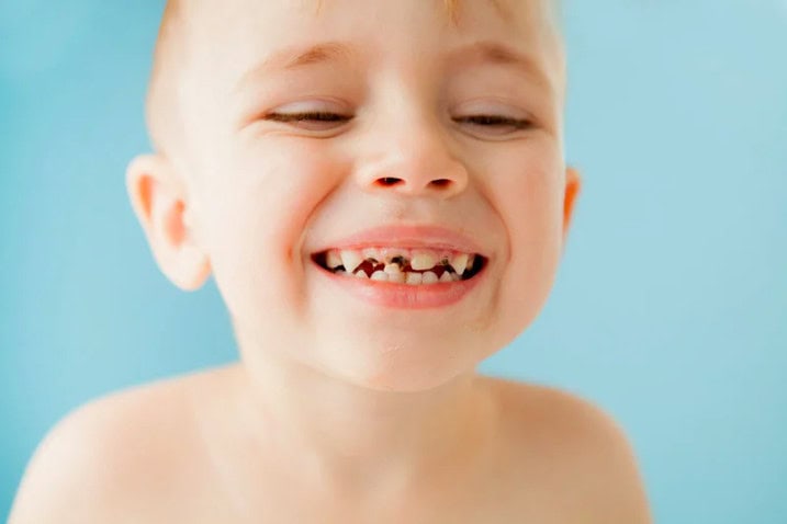 Bottle Caries