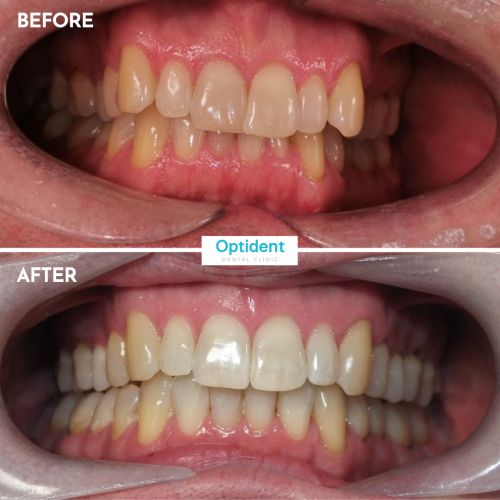 Invisalign 2