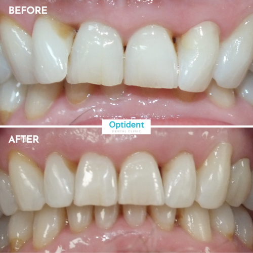 Invisalign 3