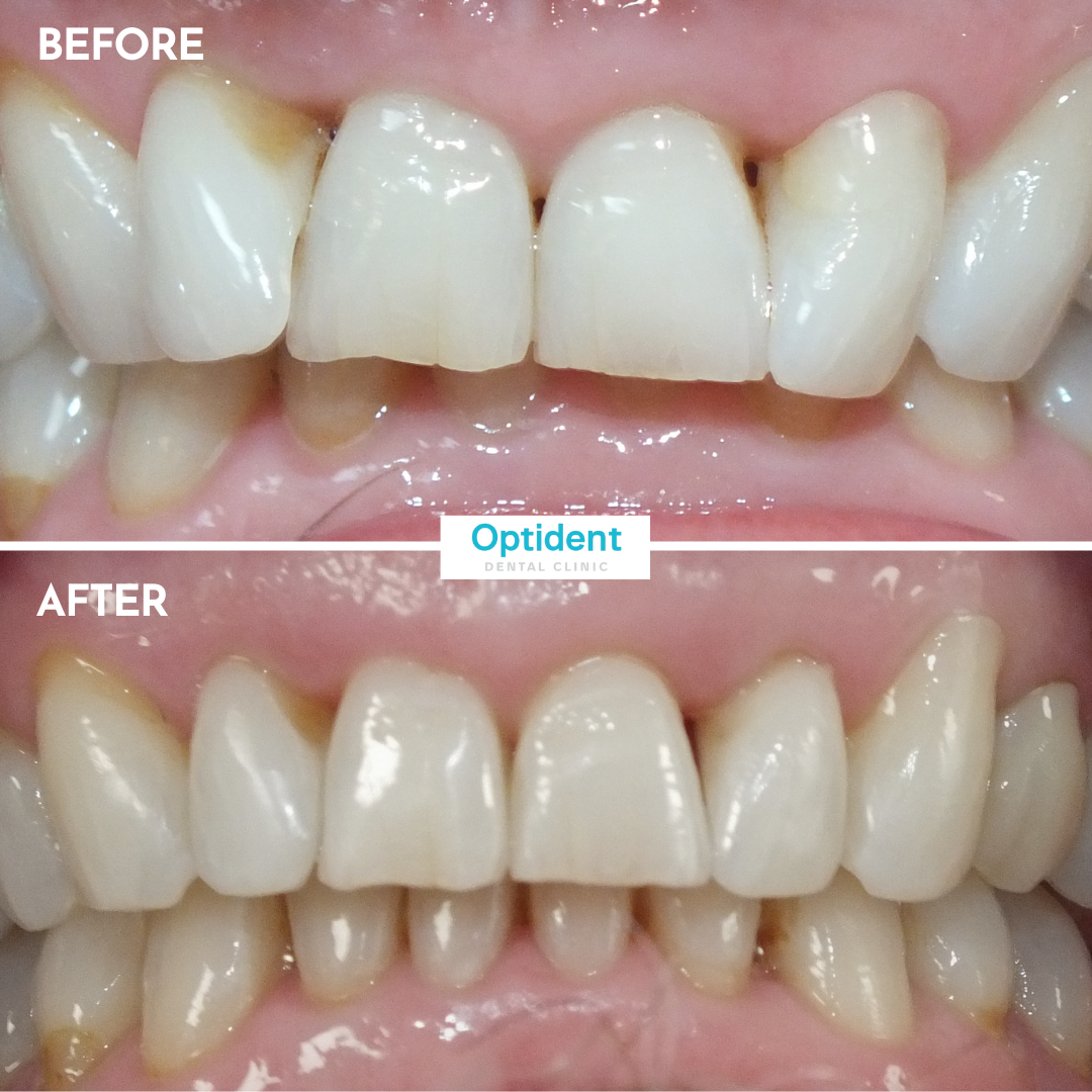 Invisalign 3