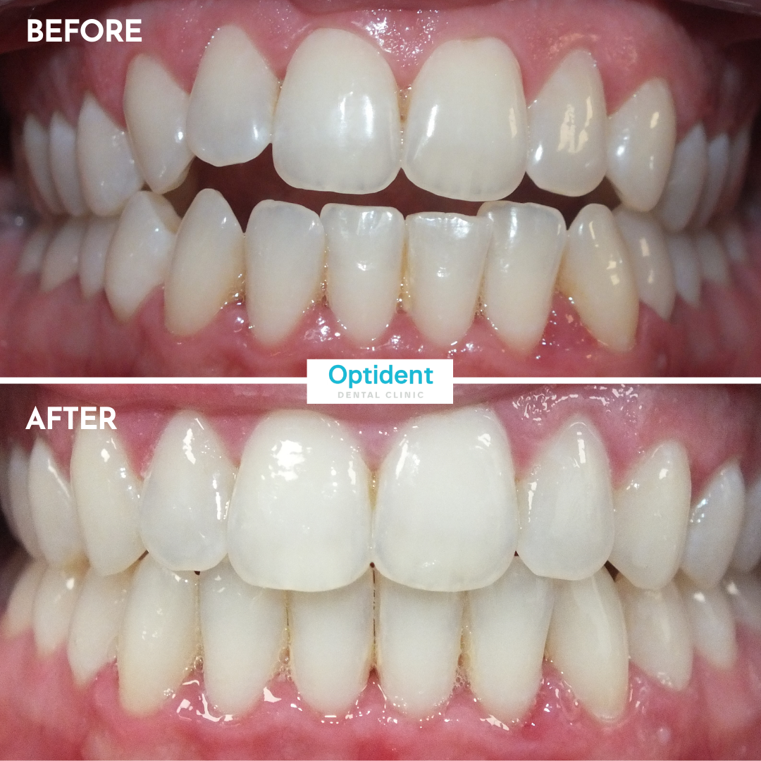 Invisalign Before & After